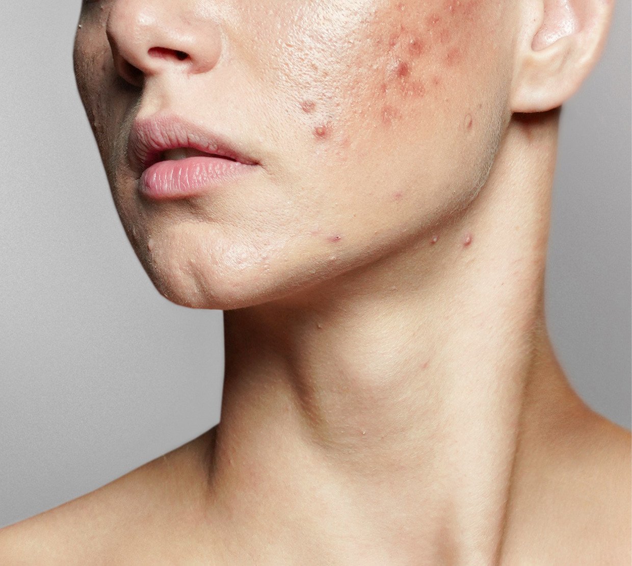skin-hangover-Pickel_595x533.jpg
