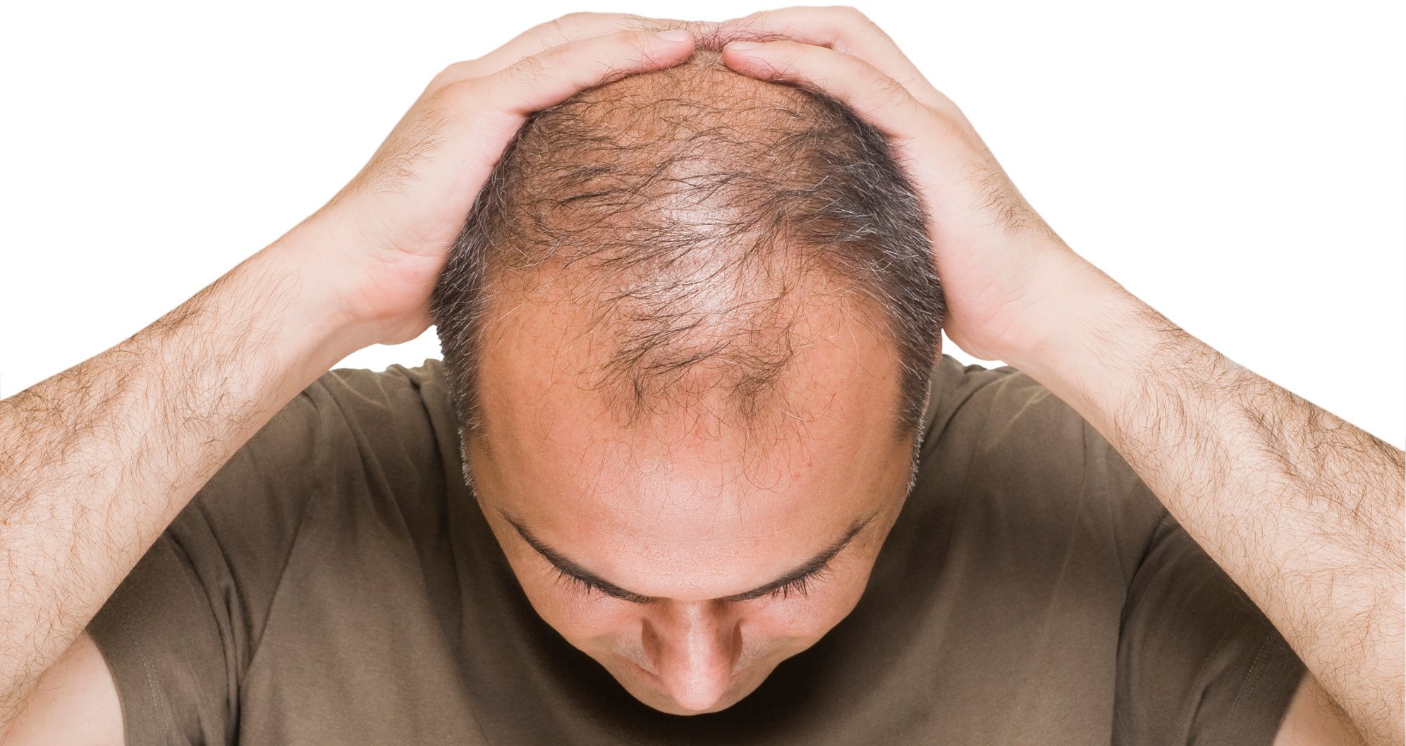 Cosmetic Services - older man from the front looking down so his hair loss can be seen