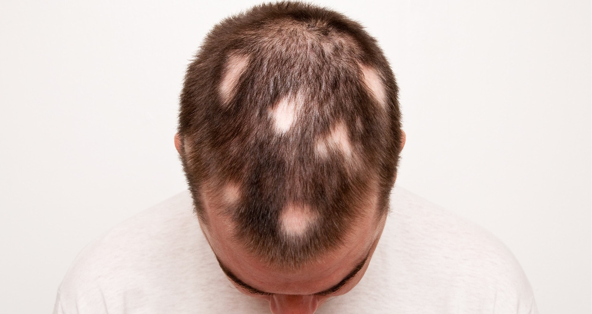 Cosmetic Services - man looking down and his hair patches on his head can be seen