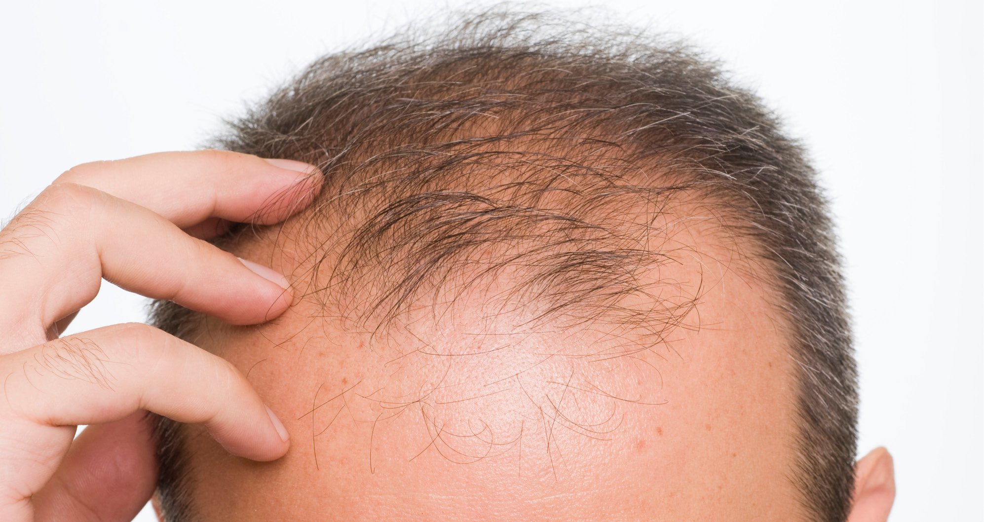 Cosmetic Services - head of older man with hair loss